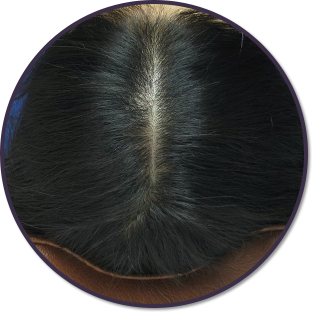 발모단계 머리사진