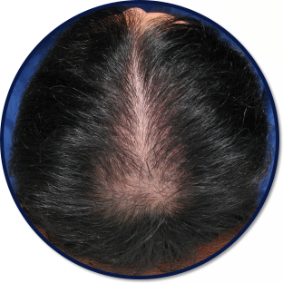 발모단계 머리사진