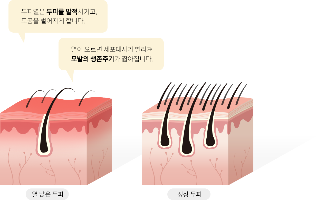 두피열은 두피를 발적시키고, 모공을 벌어지게 합니다. 열이 오르면 세포대사가 빨라져 모발의 생존주기가 짧아집니다. 열 많은 두피, 정상 두피