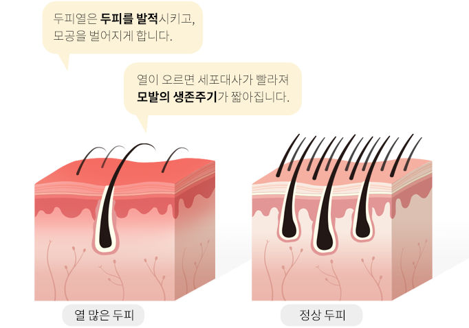 두피열은 두피를 발적시키고, 모공을 벌어지게 합니다. 열이 오르면 세포대사가 빨라져 모발의 생존주기가 짧아집니다. 열 많은 두피, 정상 두피