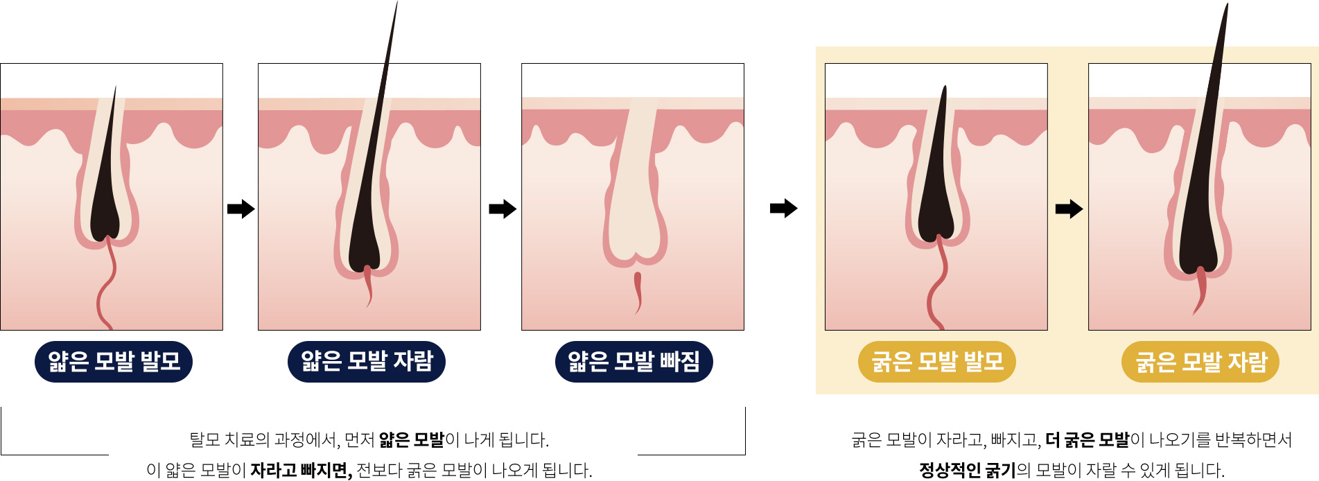 탈모 치료의 과정에서, 먼저 얇은 모발이 나게 됩니다. 이 얇은 모발이 자라고 빠지면, 전보다 굵은 모발이 나오게 됩니다. 굵은 모발이 자라고, 빠지고, 더 굵은 모발이 나오기를 반복하면서 정상적인 굵기의 모발이 자랄 수 있게 됩니다.